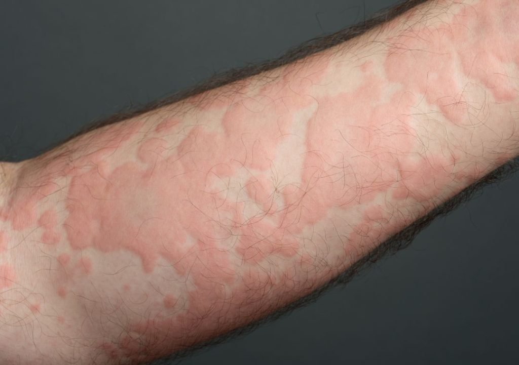 allergic reactions due to mould and fungi